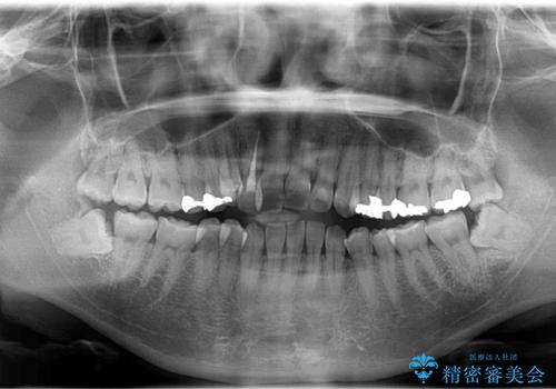 八重歯と反対咬合、下の前歯が1本少ない　インビザラインによる非抜歯治療　invisalignの治療前