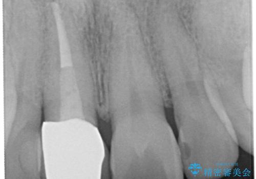 金属製の前歯をメタルフリーにしたい　単独前歯のセラミック処理の治療後