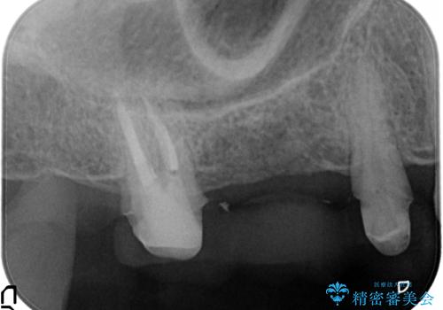 分岐部病変の奥歯→一見問題なさそうだが、抜歯しなければならないの治療中