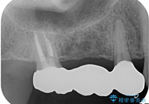 分岐部病変の奥歯→一見問題なさそうだが、抜歯しなければならないの治療後