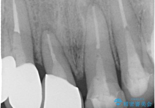 前歯のかぶせものの下に巨大な虫歯が　ぎりぎり抜歯をまぬがれるにはの症例 治療後