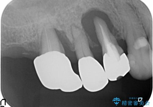 重度に吸収した歯槽骨を再建　インプラント咬合機能回復の治療前