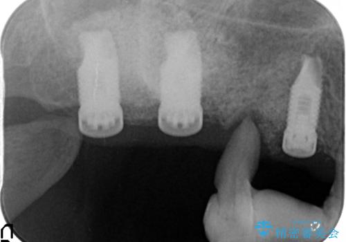 重度に吸収した歯槽骨を再建　インプラント咬合機能回復の治療後