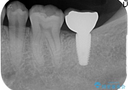 [30代男性] インプラント　失った歯の治療の治療後