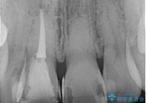 前歯の変色　見える前歯の審美改善セラミック治療の治療中