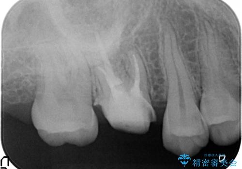オールセラミッククラウン　歯茎より深い虫歯(縁下カリエス)の治療の治療中