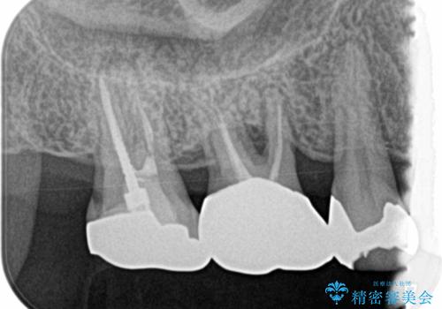 分岐部病変の奥歯→一見問題なさそうだが、抜歯しなければならないの治療前