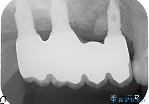 重度に吸収した歯槽骨を再建　インプラント咬合機能回復の治療後