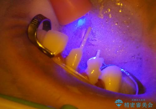 前歯のかぶせものの下に巨大な虫歯が　ぎりぎり抜歯をまぬがれるにはの治療中
