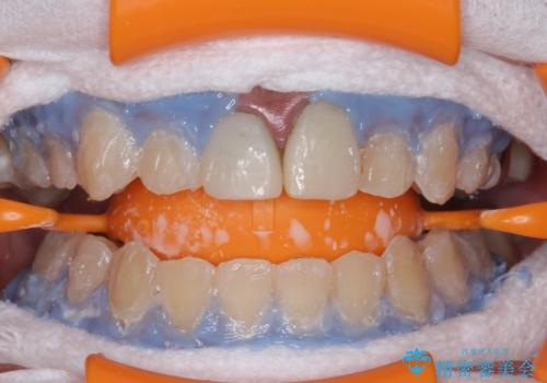 ホワイトニングエクセレントコースで歯を白く。1回目の治療中