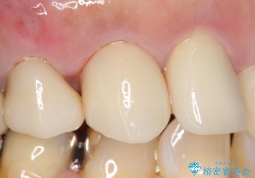 オールセラミッククラウン　歯と被せ物の隙間にできた虫歯の治療の治療後