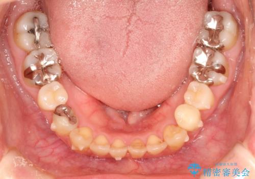 出っ歯が気になる　オープンバイトを伴う前突症のインビザライン治療・セラミック治療　invisalignの治療中