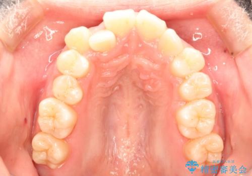 埋まった歯を出してくる矯正治療(牽引から萌出するまで)の症例 治療前