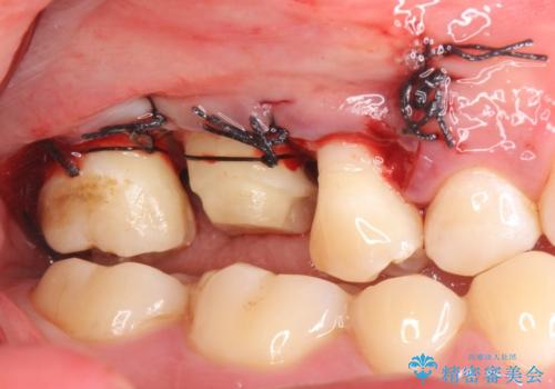 オールセラミッククラウン　歯茎より深い虫歯(縁下カリエス)の治療の治療後