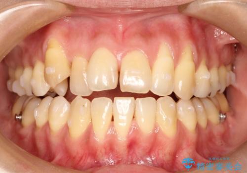 八重歯と反対咬合、下の前歯が1本少ない　インビザラインによる非抜歯治療　invisalignの治療中