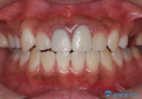 ホワイトニングエクセレントコースで歯を白く。1回目の治療後