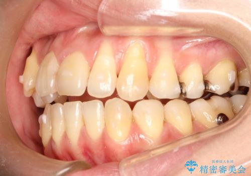 八重歯と反対咬合、下の前歯が1本少ない　インビザラインによる非抜歯治療　invisalignの治療中
