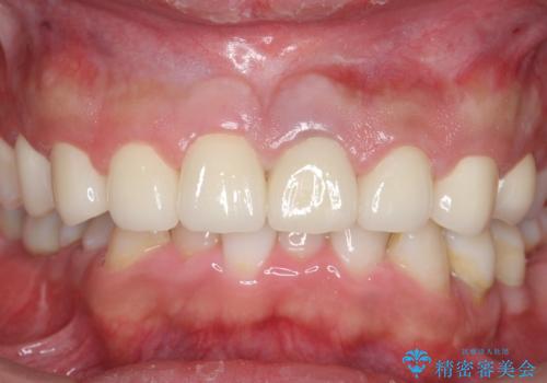 オールセラミッククラウン　全体的な歯の治療の治療後