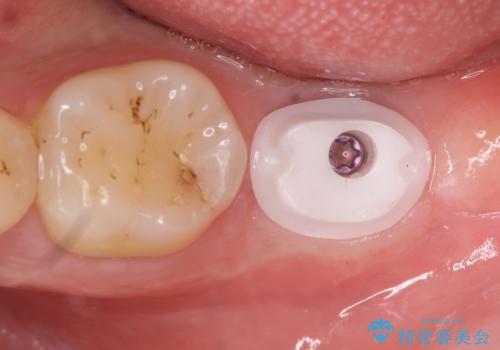 [30代男性] インプラント　失った歯の治療の治療中