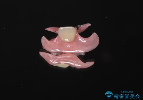 前歯の入れ歯　金属の見えないノンクラスプデンチャー