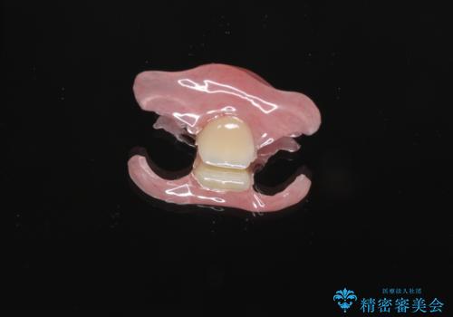 前歯の入れ歯　金属の見えないノンクラスプデンチャーの治療前