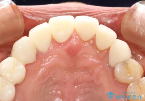 前歯のかぶせものの下に巨大な虫歯が　ぎりぎり抜歯をまぬがれるにはの治療後