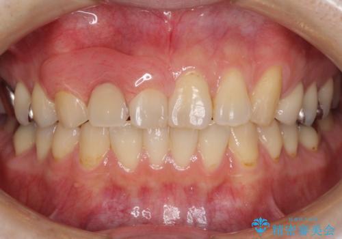 前歯の入れ歯　金属の見えないノンクラスプデンチャーの治療後