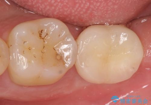 [30代男性] インプラント　失った歯の治療の症例 治療後
