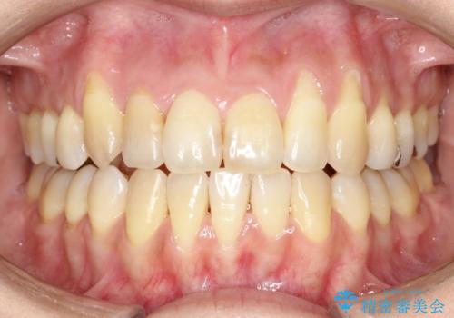 八重歯と反対咬合、下の前歯が1本少ない　インビザラインによる非抜歯治療　invisalignの治療後