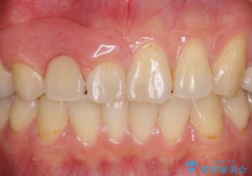 前歯の入れ歯　金属の見えないノンクラスプデンチャーの症例 治療後