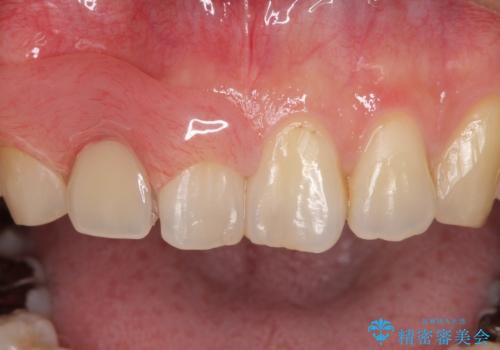 前歯の入れ歯　金属の見えないノンクラスプデンチャーの治療中