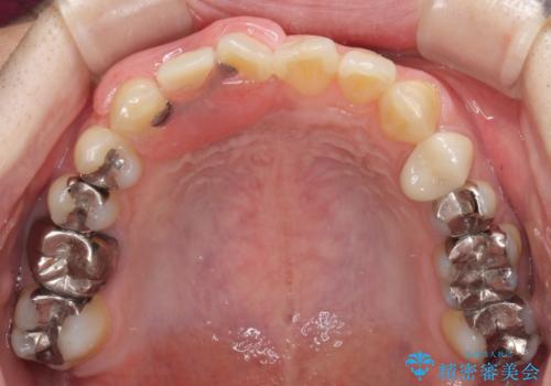 前歯の入れ歯　金属の見えないノンクラスプデンチャーの治療後