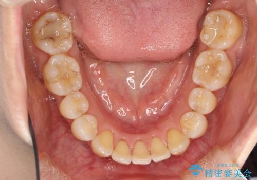 八重歯と反対咬合、下の前歯が1本少ない　インビザラインによる非抜歯治療　invisalignの治療後