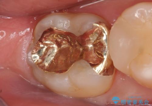 PGA(ゴールド)インレー　虫歯治療