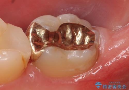 PGA(ゴールド)インレー　虫歯治療の治療後