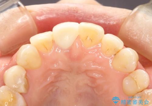 金属製の前歯をメタルフリーにしたい　単独前歯のセラミック処理の治療後