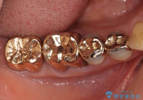 割れた奥歯　ゴールドブリッジによる補綴治療の症例 治療前