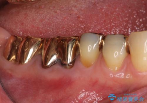 割れた奥歯　ゴールドブリッジによる補綴治療の治療前