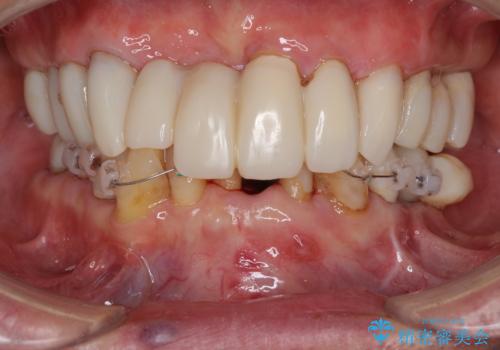 ボロボロの歯を何とかしたい　総合歯科治療による全顎治療の治療中