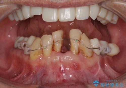 ボロボロの歯を何とかしたい　総合歯科治療による全顎治療の治療中
