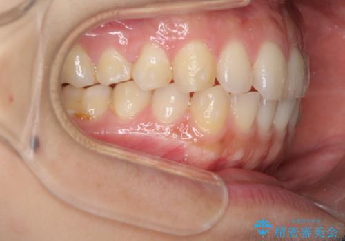 インビザラインで前歯のガタつきの改善の治療中