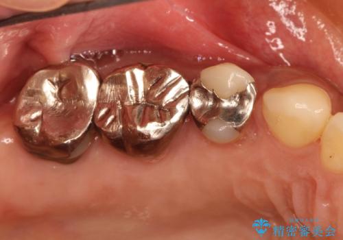 分岐部病変の奥歯→一見問題なさそうだが、抜歯しなければならないの症例 治療前