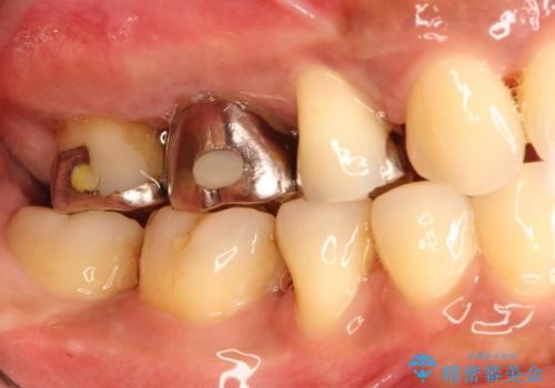 分岐部病変の奥歯→一見問題なさそうだが、抜歯しなければならないの治療前