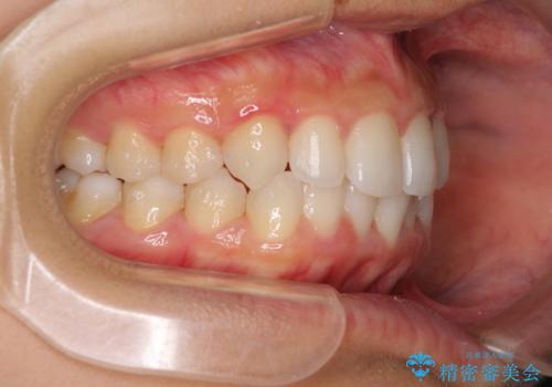 前歯のデコボコを治したい　インビザラインによる非抜歯矯正治療の治療中