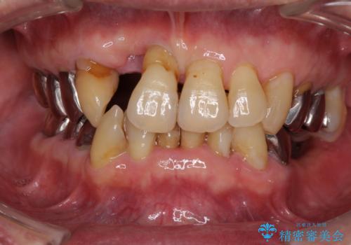 ボロボロの歯を何とかしたい　総合歯科治療による全顎治療の症例 治療前