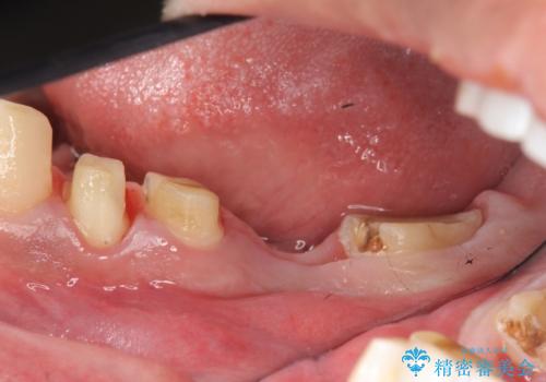 オールセラミッククラウン　歯冠長延長術　歯の高さが低い歯の治療の治療前