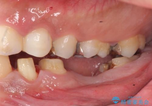 オールセラミッククラウン　歯冠長延長術　歯の高さが低い歯の治療の治療前
