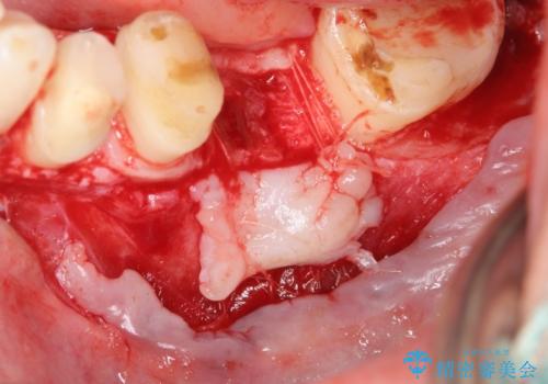 オールセラミッククラウン　歯冠長延長術　歯の高さが低い歯の治療の治療中
