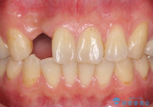 前歯の入れ歯　金属の見えないノンクラスプデンチャーの症例 治療前