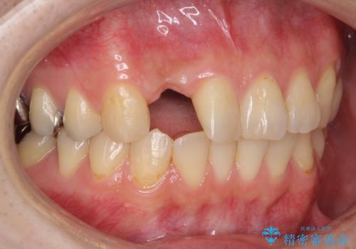 前歯の入れ歯　金属の見えないノンクラスプデンチャーの治療前